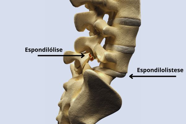 Entendendo a diferença entre Espondilólise e Espondilolistese