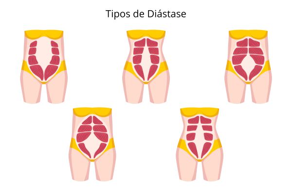 Diástase Abdominal: Pilates como Aliado no Pós-Parto